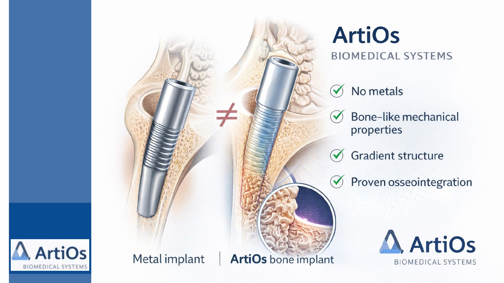 Primerjava kovinskega in ArtiOs polimernega implantata
